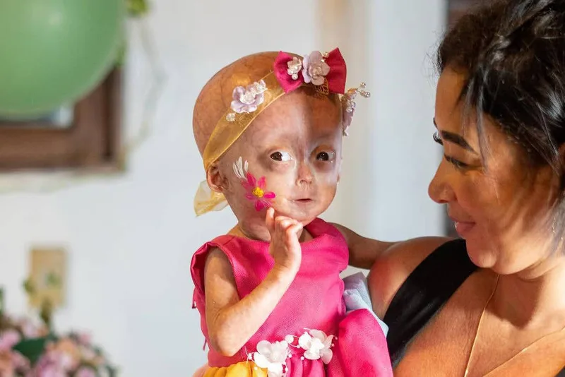 Morre aos cinco anos menina com progéria em Boa Vista