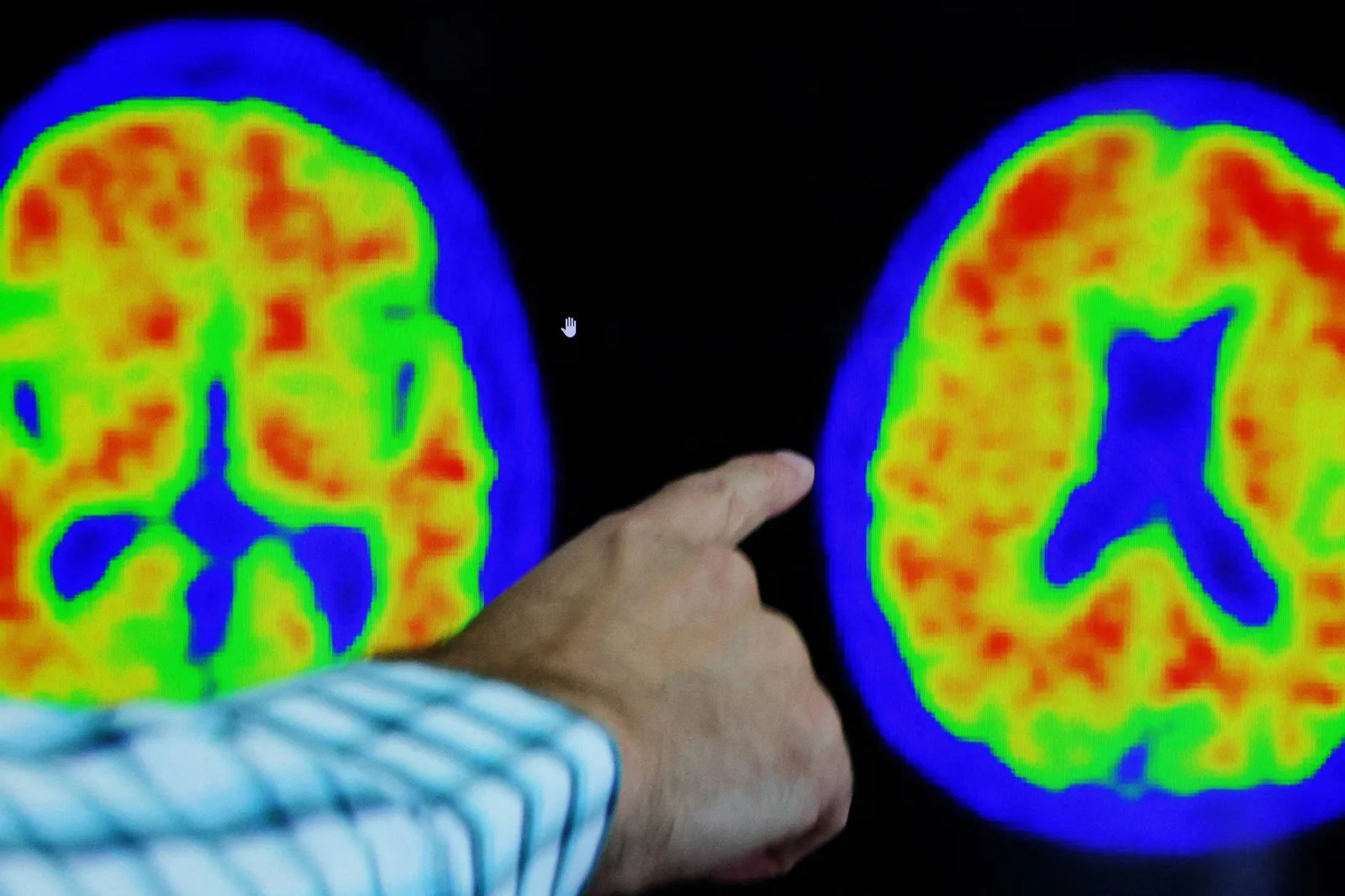 Diagnóstico do Alzheimer ganha opção sanguínea, mas exige avaliação médica