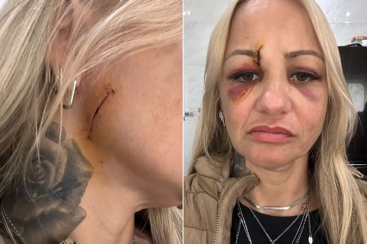 Cabeleireira é ferida no rosto com taça de vidro em Praia Grande