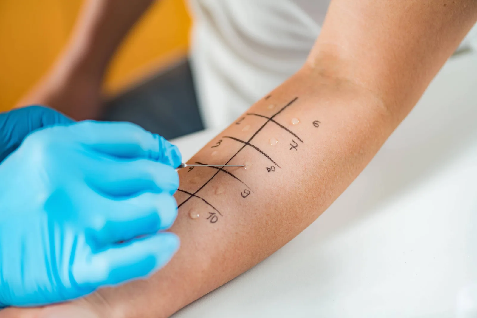 Anafilaxia pode evoluir rapidamente e exige prevenção e atendimento imediato