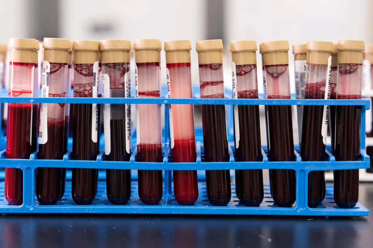 Einstein oferece teste de sangue que rastreia sinais de mais de 50 cânceres